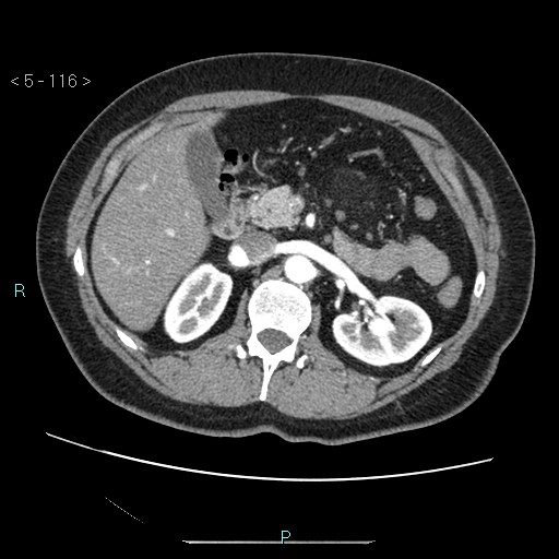 Bronchogenic cyst - posterior mediastinal (Radiopaedia 43885-47364 A 67).jpg