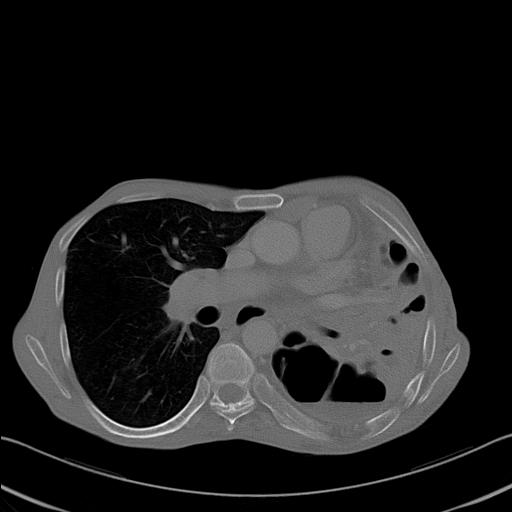 File:Bronchopleural fistula secondary to tuberculosis (Radiopaedia 20415-20322 Axial bone window 15).jpg