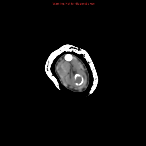 Brown tumor (Radiopaedia 12460-12694 Axial non-contrast 44).jpg