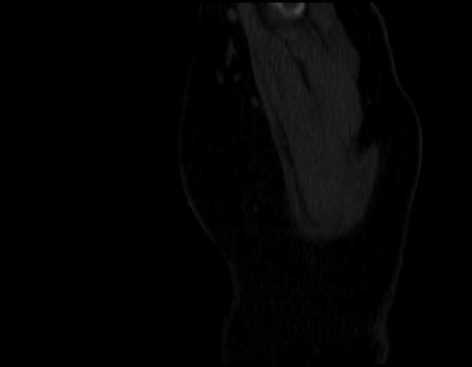Brown tumors compressing the spinal cord (Radiopaedia 68442-77988 Sagittal bone window 2).jpg