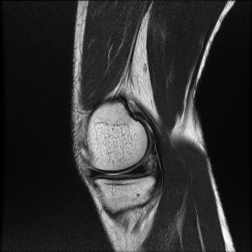 File:Bucket-handle meniscus tear (Radiopaedia 65700-74809 Sagittal T2 6).jpg