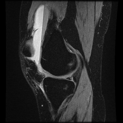 Bucket handle meniscus tear (Radiopaedia 56916-63751 H 55).jpg