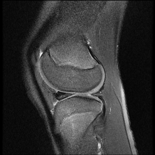 File:Bucket handle tear - lateral meniscus (Radiopaedia 72124-82634 Sagittal PD fat sat 4).jpg