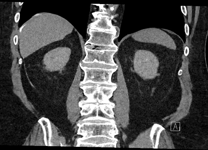 Buried bumper syndrome - gastrostomy tube (Radiopaedia 63843-72577 Coronal Inject 98).jpg