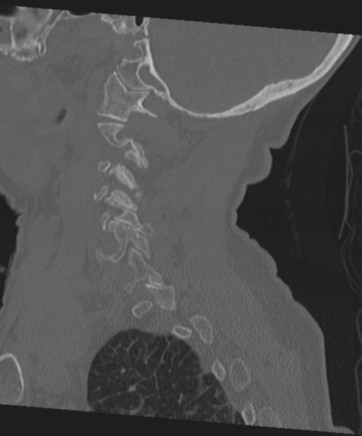 C2 fracture with vertebral artery dissection (Radiopaedia 37378-39199 Sagittal bone window 55).png