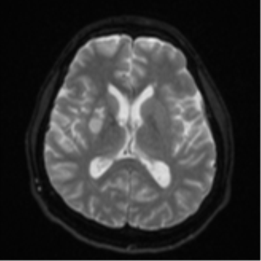 File:CNS vasculitis (Radiopaedia 55715-62263 Axial DWI 16).png