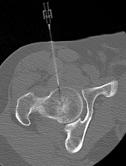 File:CT-guided hip injection (Radiopaedia 16378).jpg