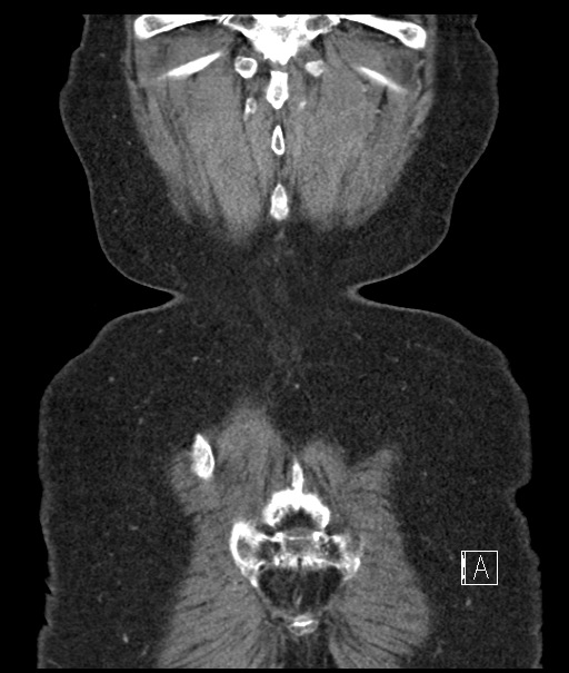 Calcified adrenal glands and Spigelian hernia (Radiopaedia 49741-54988 B 111).jpg