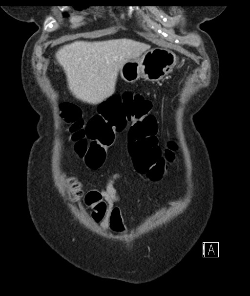 Calcified adrenal glands and Spigelian hernia (Radiopaedia 49741-54988 B 18).jpg