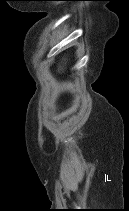 Calcified adrenal glands and Spigelian hernia (Radiopaedia 49741-54988 C 149).jpg