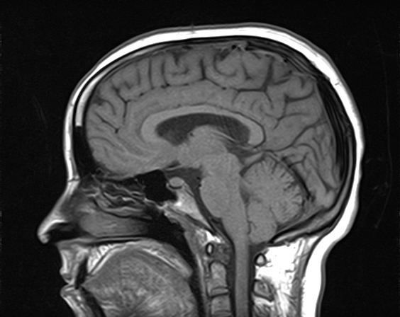 File:Calcified cerebral hydatid cyst (Radiopaedia 65603-74699 Sagittal T1 10).jpg