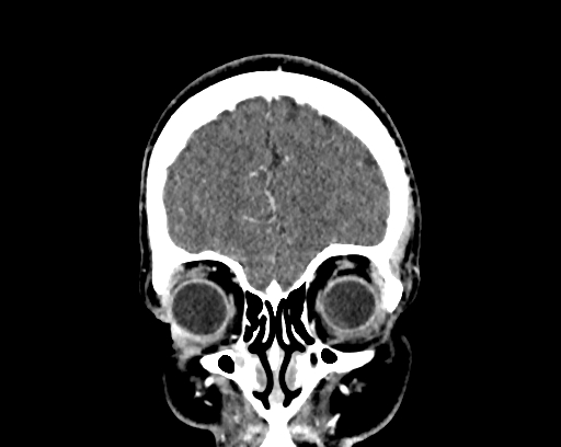 Calcified cerebral hydatid cyst (Radiopaedia 65603-74717 C 9).jpg