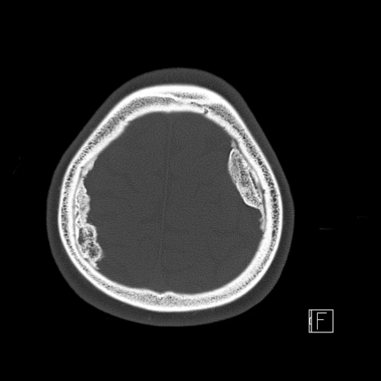 File:Calcified chronic subdural hematoma (Radiopaedia 77374-89492 Axial bone window 118).jpg