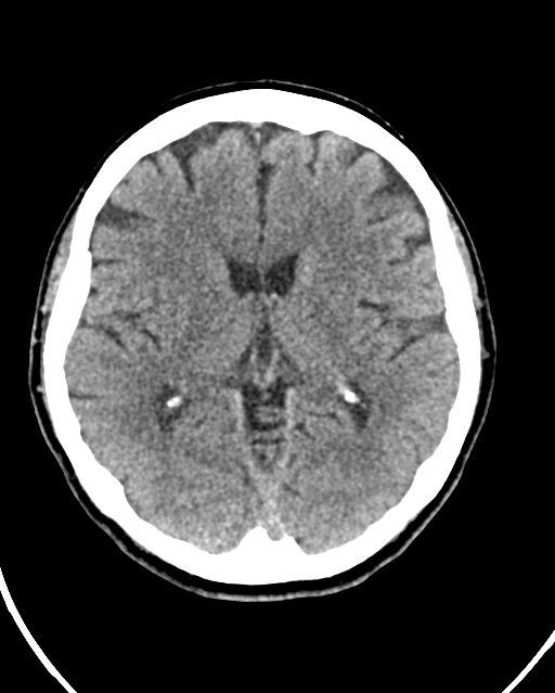 Calcified meningioma (Radiopaedia 74361-85243 Axial non-contrast 25).jpg