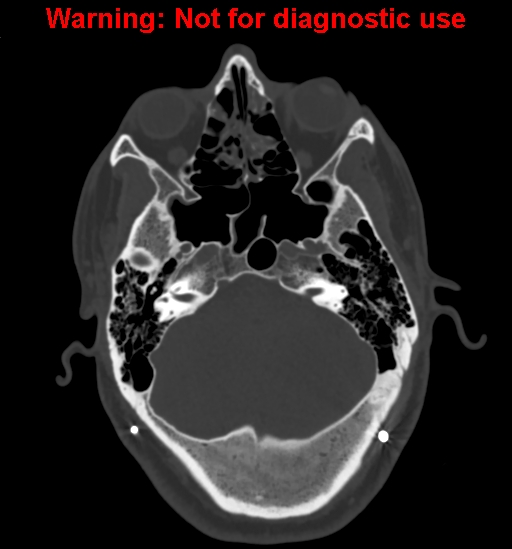 Calvarial thickening from chronic shunting (Radiopaedia 60079-67637 Axial bone window 43).jpg