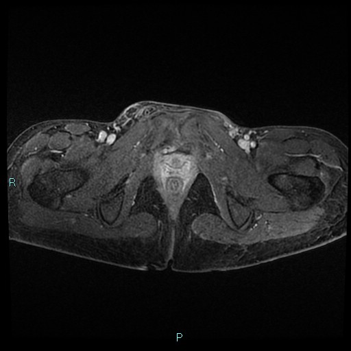 File:Canal of Nuck cyst (Radiopaedia 55074-61448 Axial T1 C+ fat sat 49).jpg