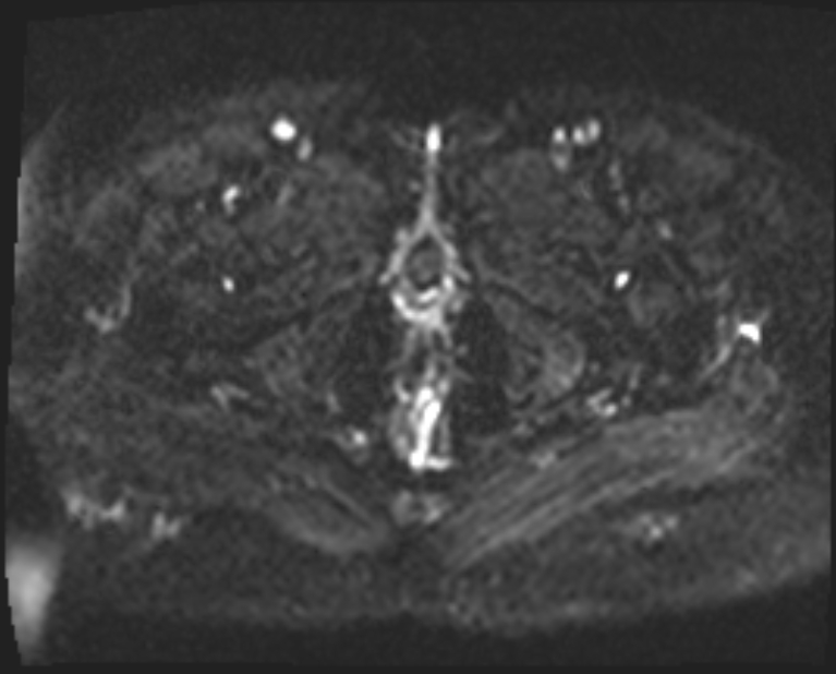 Cancer cervix - stage IIb (Radiopaedia 75411-86615 Axial DWI 3).jpg