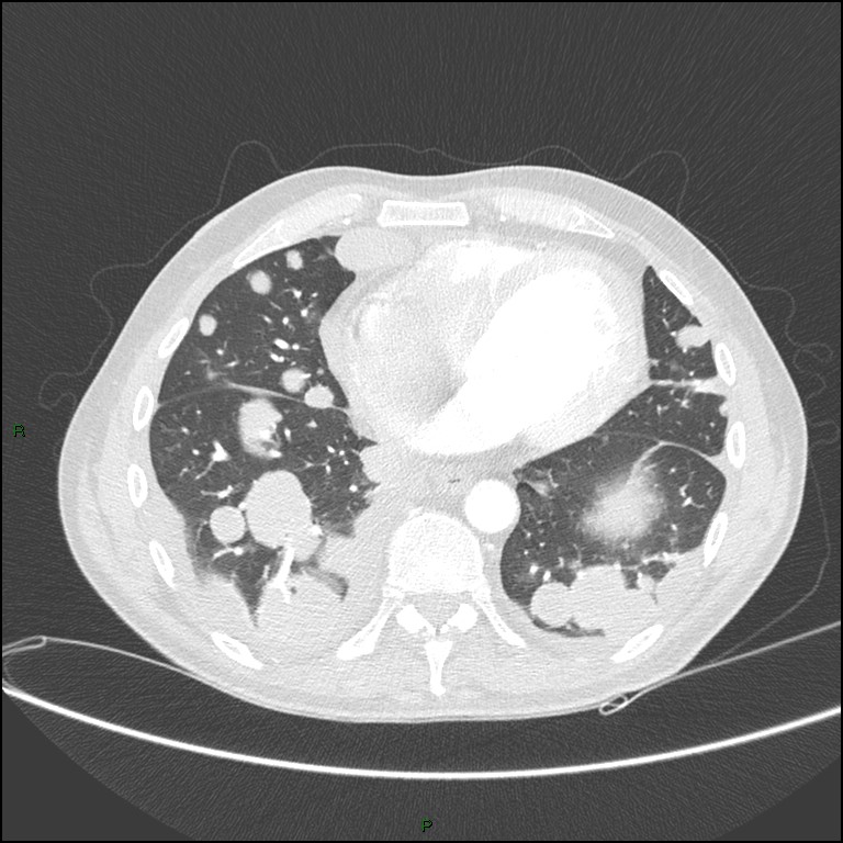 Cannonball metastases (Radiopaedia 82110-96150 Axial lung window 134).jpg