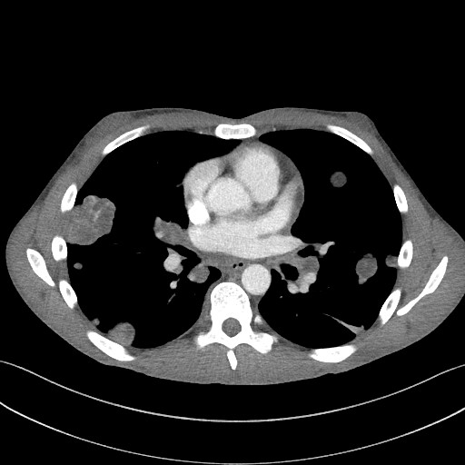 Cannonball metastases - testicular choriocarcinoma (Radiopaedia 84510-99891 B 62).jpg