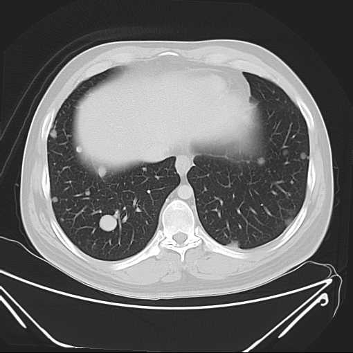 File:Cannonball pulmonary metastases (Radiopaedia 67684-77101 Axial lung window 20).jpg