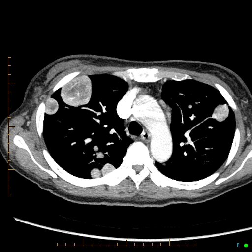 File:Canonball lung metastasis (Radiopaedia 77634-89837 B 29).jpg