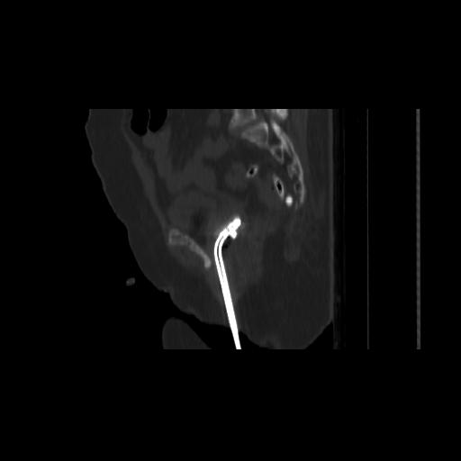 Carcinoma cervix- brachytherapy applicator (Radiopaedia 33135-34173 Sagittal bone window 109).jpg