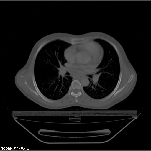 File:Carcinoma of esophagus (Radiopaedia 27356-27550 Axial bone window 18).jpg