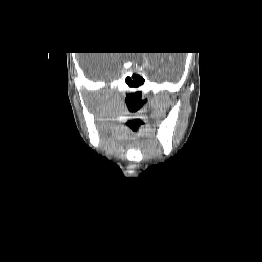 Carcinoma of the maxillary antrum (Radiopaedia 53805-59888 Coronal C+ delayed 72).jpg