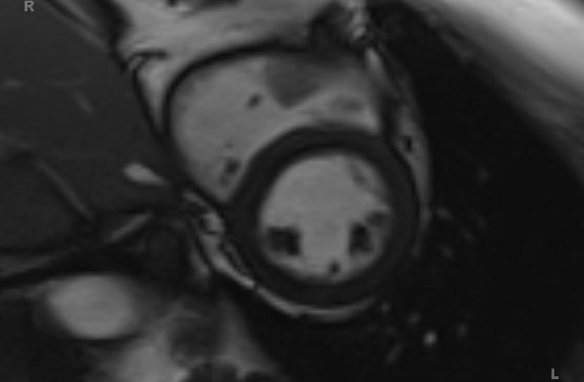 Cardiac hemangioma (Radiopaedia 31709-32631 Short axis Cine SSFP 4).jpg