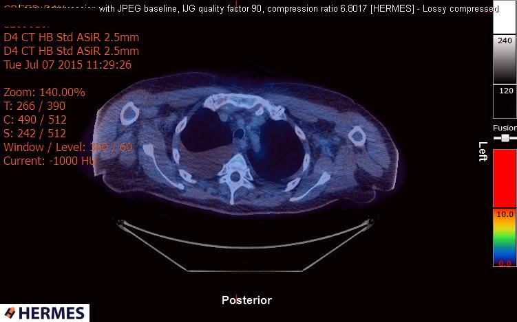 File:Cardiac lymphoma (Radiopaedia 38690-40871 Integrated PET-CT 2).jpg