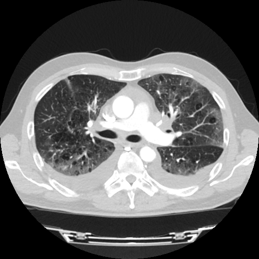Cardiac tamponade (Radiopaedia 78607-91368 Axial lung window 33).jpg