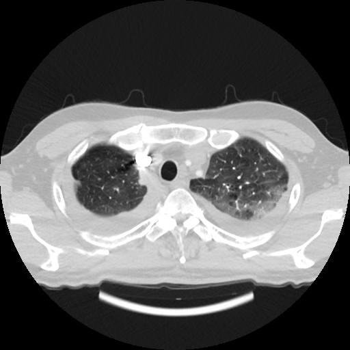 File:Cardiac tamponade (Radiopaedia 78607-91368 Axial lung window 9).jpg