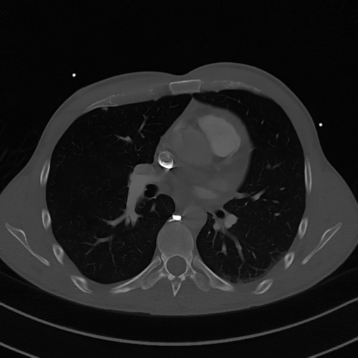 Cardiac tumor - undifferentiated pleomorphic sarcoma (Radiopaedia 45844-50134 Axial bone window 34).png