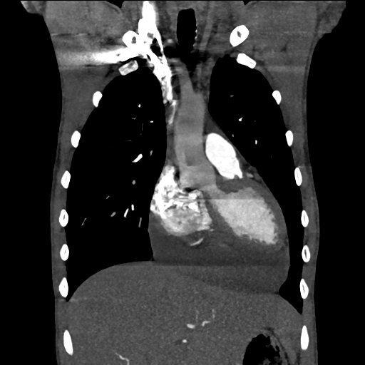Cardiac tumor - undifferentiated pleomorphic sarcoma (Radiopaedia 45844-50134 Coronal non-contrast 22).png