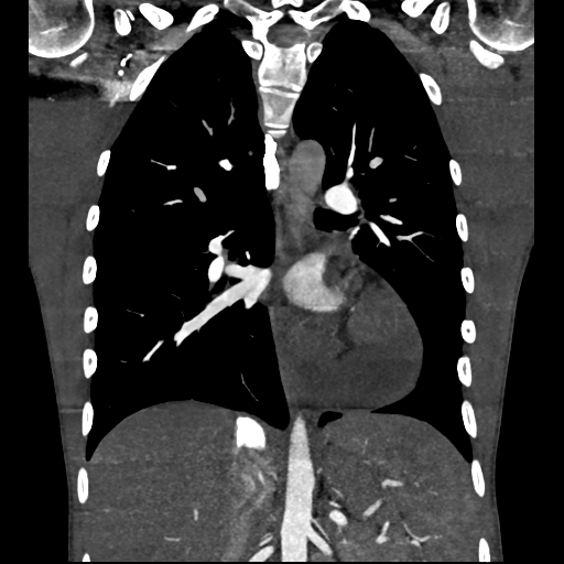 Cardiac tumor - undifferentiated pleomorphic sarcoma (Radiopaedia 45844-50134 Coronal non-contrast 41).png