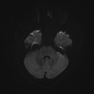 Cardioembolic stroke- ACA and MCA territories (Radiopaedia 58904-66136 Axial DWI 33).jpg