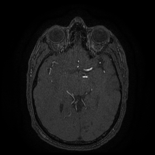 Carotid arterial dissection with acute cerebral infarction (Radiopaedia 26636-26784 MRA 90).jpg