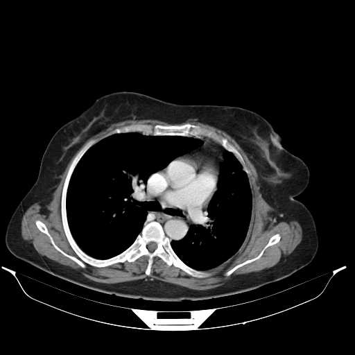 File:Carotid body tumor (Radiopaedia 21021-20948 A 35).jpg