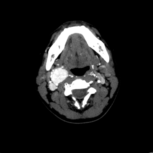 File:Carotid body tumor (Radiopaedia 39845-42300 B 43).jpg