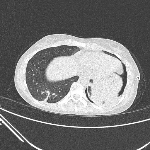 Catamenial pneumothorax (Radiopaedia 27946-28197 lung window 126).jpg