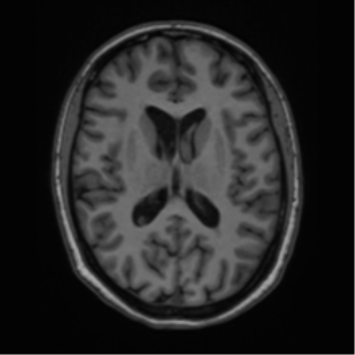 Cavernoma with bleed - midbrain (Radiopaedia 54546-60774 Axial T1 27).png