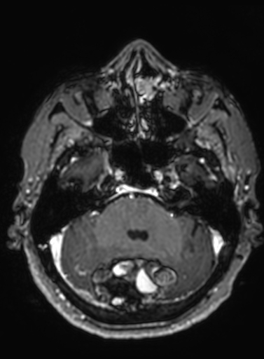File:Cavernous hemangioma of the cerebellar falx (Radiopaedia 73025-83724 Axial T1 C+ 249).jpg