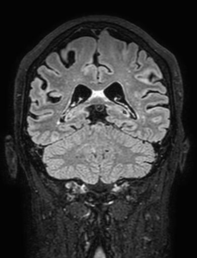 Cavernous hemangioma of the cerebellar falx (Radiopaedia 73025-83724 Coronal FLAIR 234).jpg