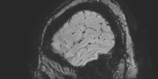Cavernous hemangioma of the cerebellar falx (Radiopaedia 73025-83724 Sagittal BOLD 18).jpg