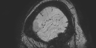 Cavernous hemangioma of the cerebellar falx (Radiopaedia 73025-83724 Sagittal BOLD 187).jpg