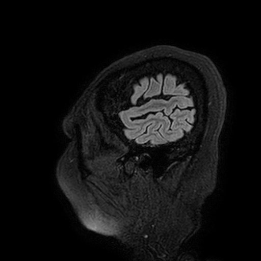 Cavernous hemangioma of the cerebellar falx (Radiopaedia 73025-83724 Sagittal FLAIR 9).jpg