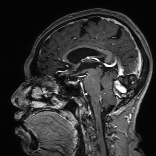 File:Cavernous hemangioma of the cerebellar falx (Radiopaedia 73025-83724 Sagittal T1 C+ 103).jpg