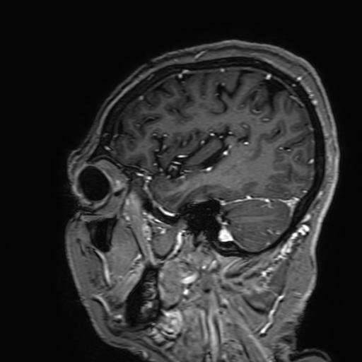Cavernous hemangioma of the cerebellar falx (Radiopaedia 73025-83724 Sagittal T1 C+ 164).jpg