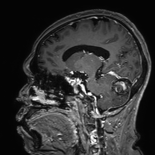 Cavernous hemangioma of the cerebellar falx (Radiopaedia 73025-83724 Sagittal T1 C+ 88).jpg