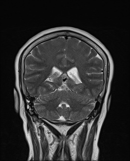 File:Cavernous sinus meningioma (Radiopaedia 63682-72367 Coronal T2 14).jpg